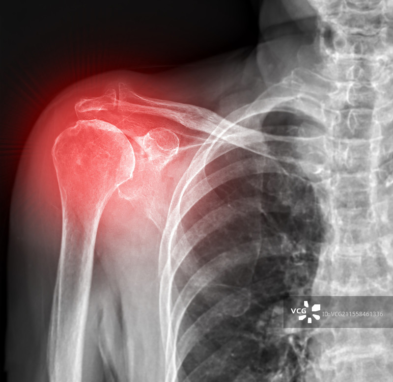 肩关节，X光片图片素材