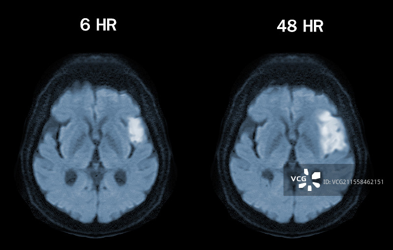中风后的大脑，MRI扫描图片素材