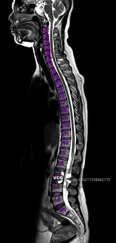 健康的脊柱，脊髓造影图片素材