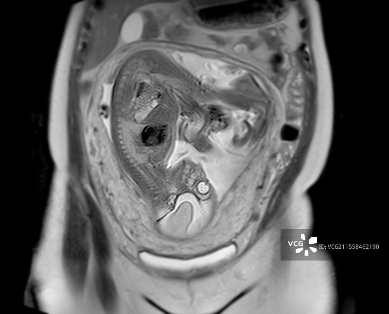 健康的胎儿，MRI扫描图片素材