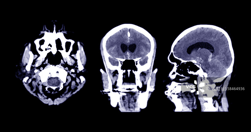 蛛网膜下腔出血，CT扫描图片素材