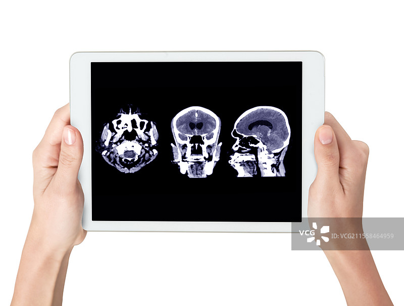 蛛网膜下腔出血诊断概念图图片素材