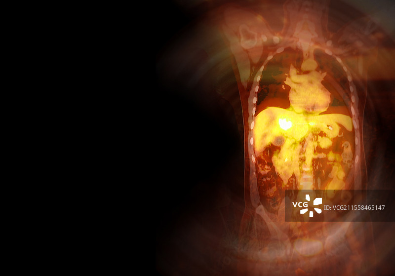 胆管癌，PET-CT扫描图片素材