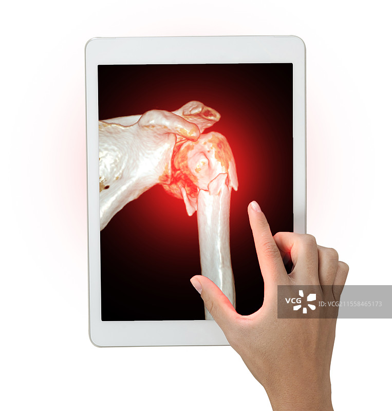 肱骨骨折，概念图图片素材