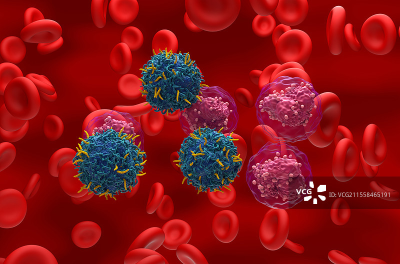 急性淋巴细胞白血病的CAR-T细胞疗法插图图片素材