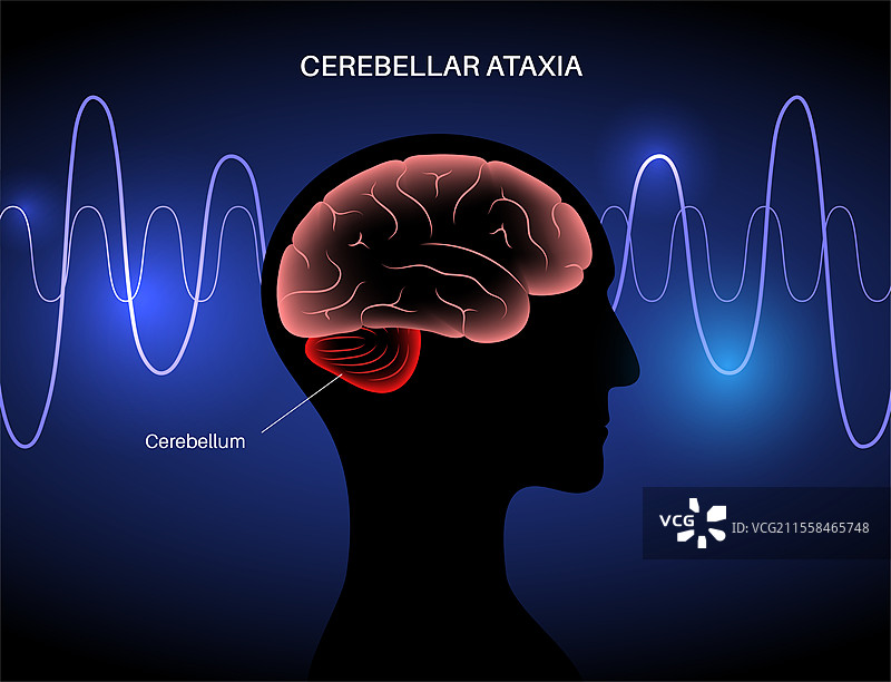 小脑共济失调症，概念插图图片素材