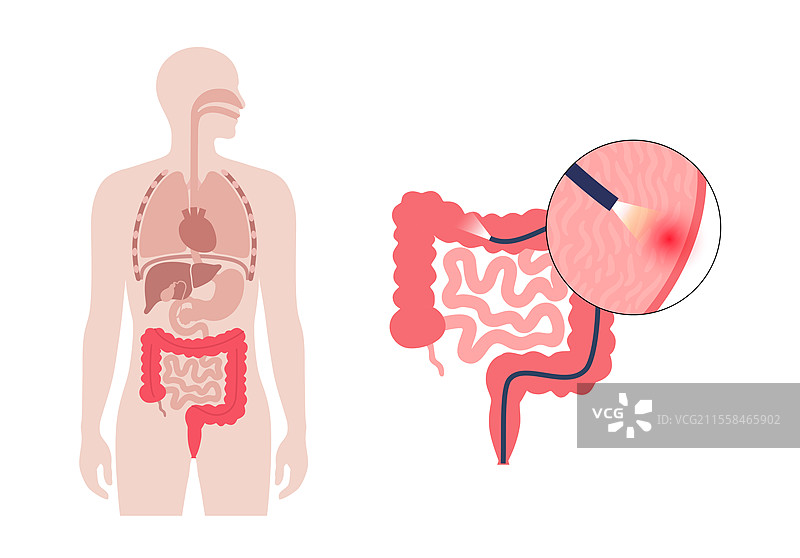 结肠镜检查过程的概念插图图片素材