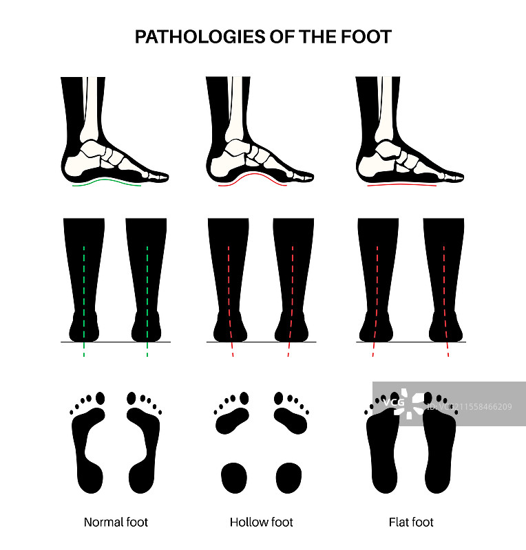 足部病理学，概念插图图片素材