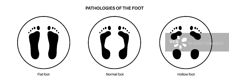 足部病理的概念插图图片素材