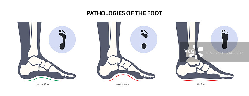 足部病理学，概念插图图片素材