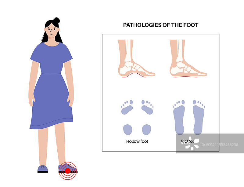 足部病理学，概念插图图片素材