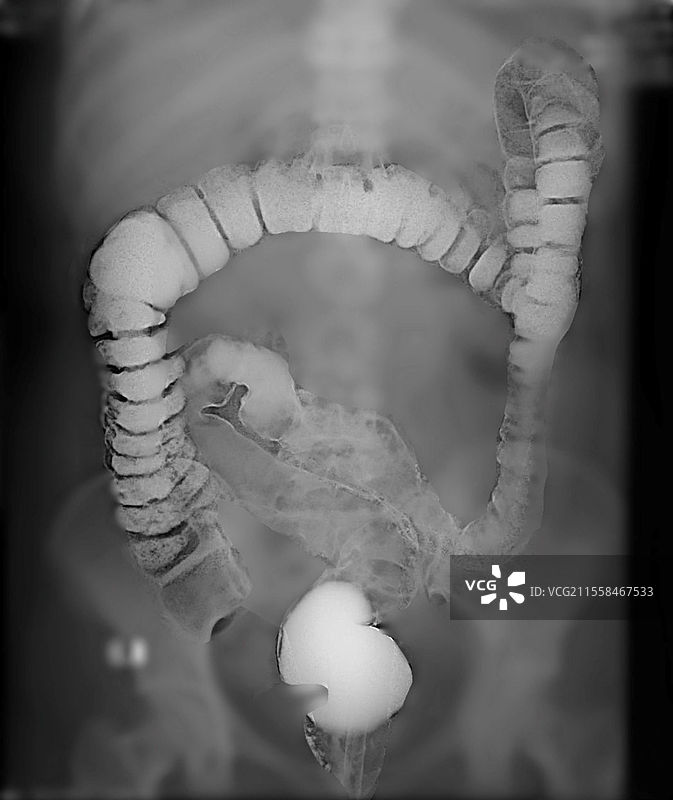 健康的结肠，X光检查图片素材