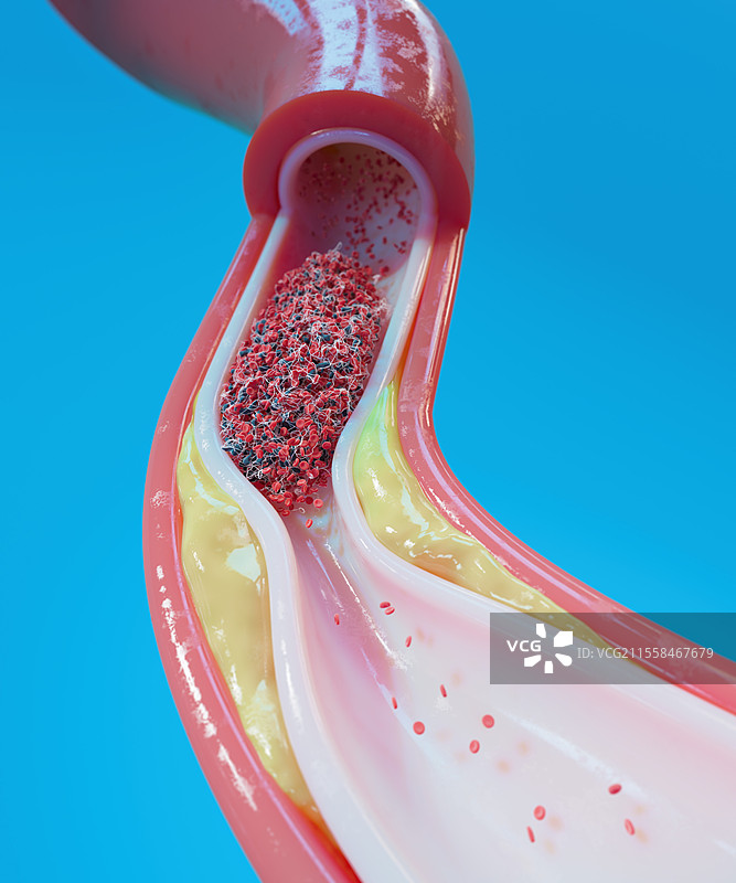 人类血管中的动脉粥样硬化和血栓插图图片素材