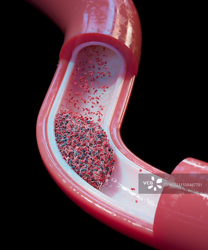 血管中的血块插图图片素材