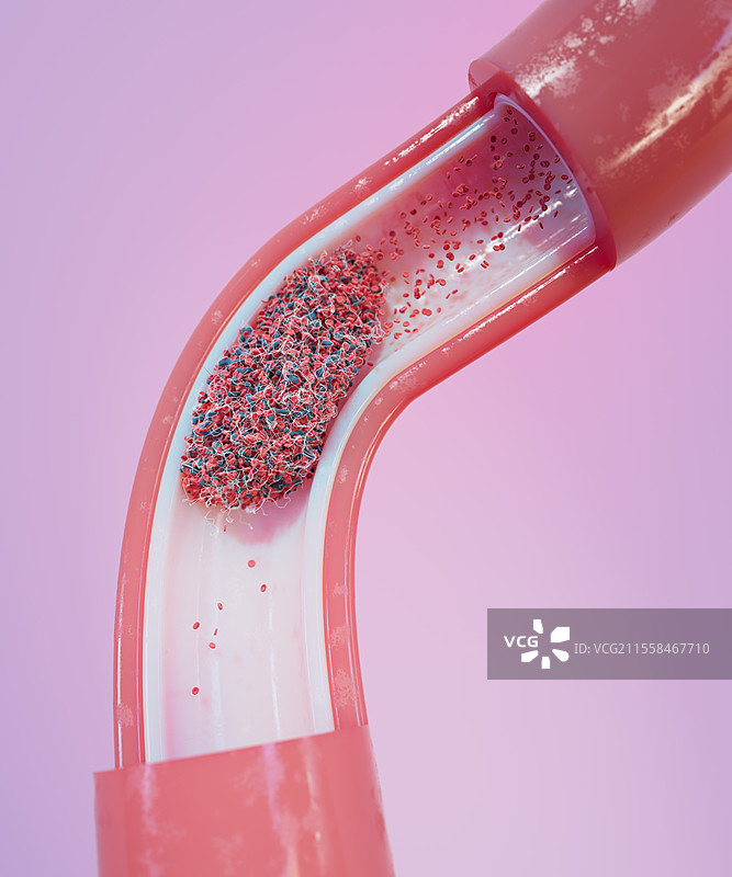 血管中的血栓插图图片素材