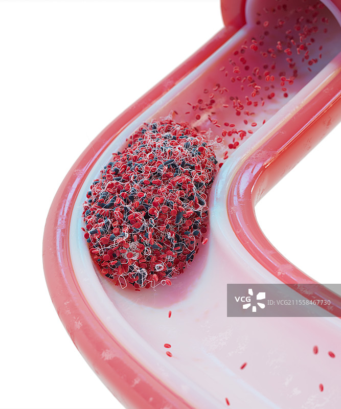 血管中的血栓，插图图片素材