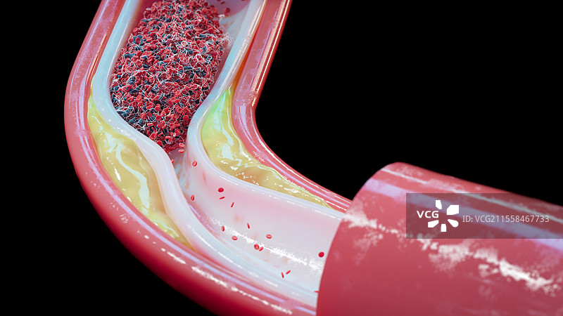 人类血管中的动脉粥样硬化和血栓插图图片素材