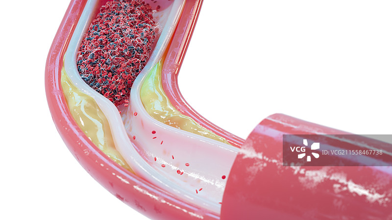 人类血管中的动脉粥样硬化和血栓插图图片素材