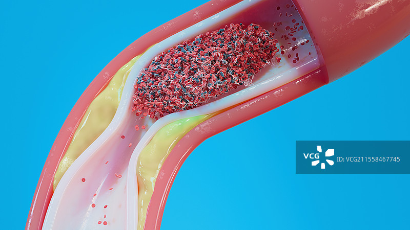 人类血管中的动脉粥样硬化和血栓插图图片素材