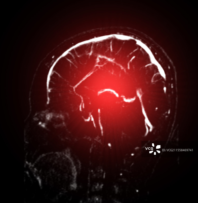 健康的脑静脉，MRV扫描图片素材