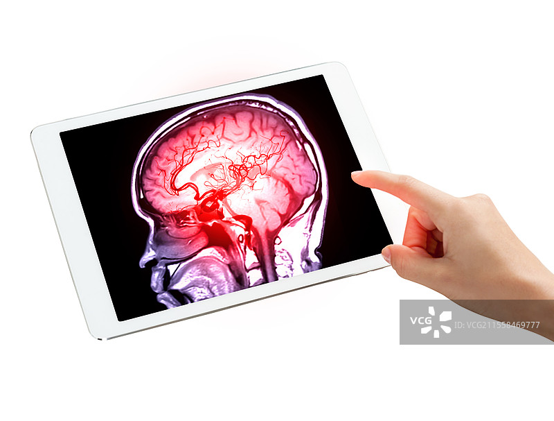 平板电脑上的脑血管造影，概念图图片素材