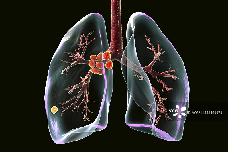 初级肺结核插图图片素材