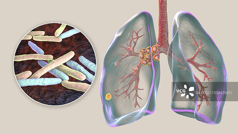 初级肺结核伴Ranke复合体插图图片素材