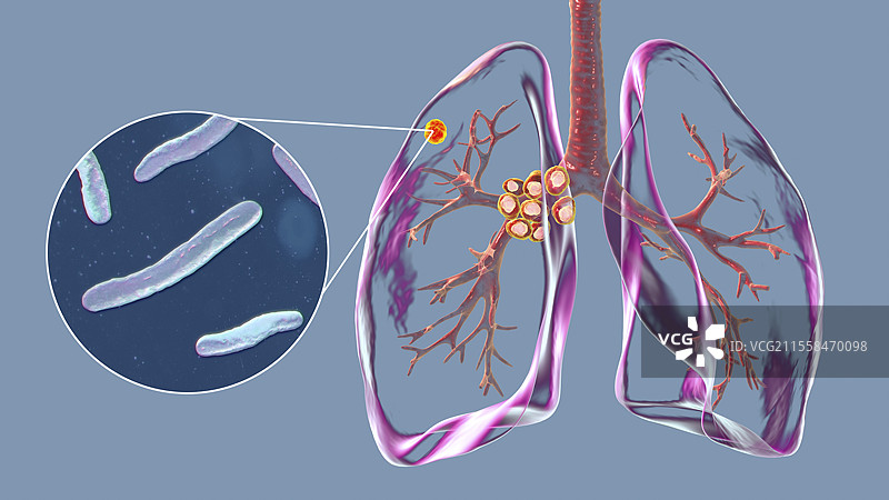 初级肺结核伴Ranke复合体插图图片素材