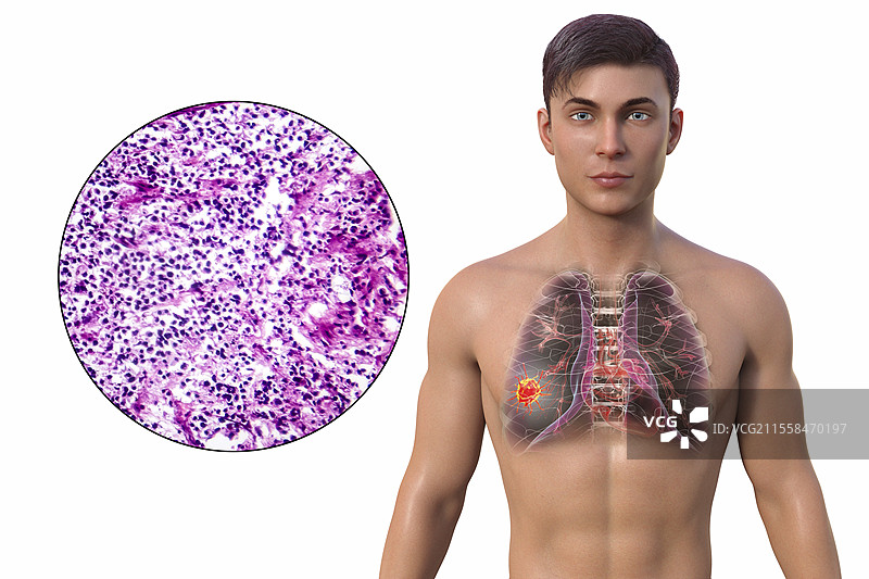 肺癌患者，插图和光学显微镜图像图片素材