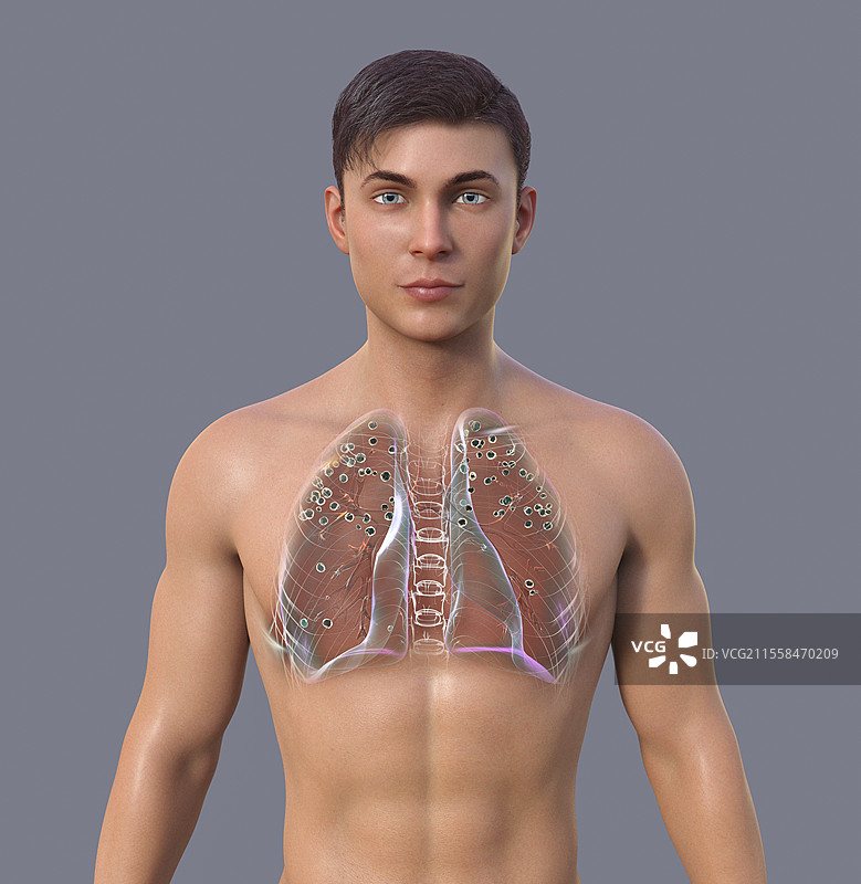 肺硅病患者，插图图片素材