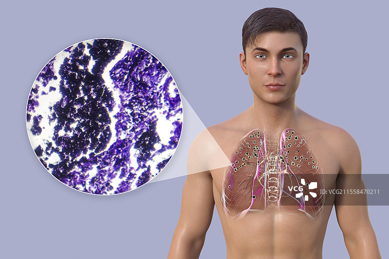 肺硅肺病男性，插图和光学显微镜图像图片素材