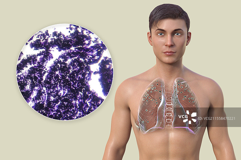 肺硅肺病患者，插图和光学显微镜图像图片素材