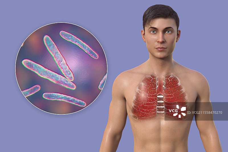 军事性结核病插图图片素材