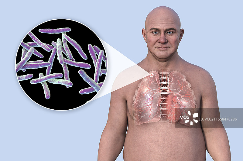 继发性结核病插图图片素材