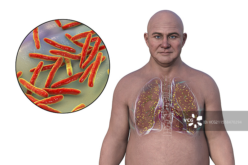 军事性结核病插图图片素材