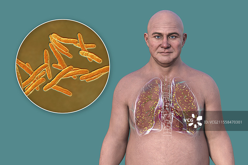 军事性结核病插图图片素材