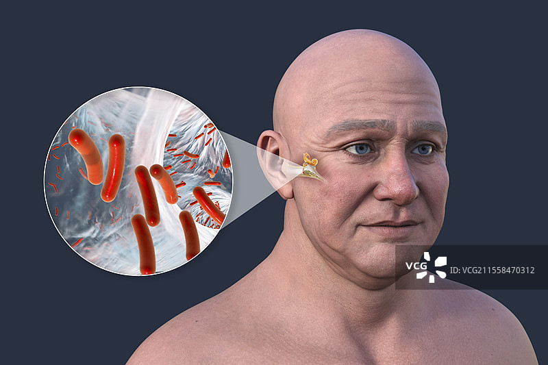 男性中耳炎插图图片素材