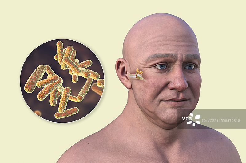 男性中耳炎插图图片素材