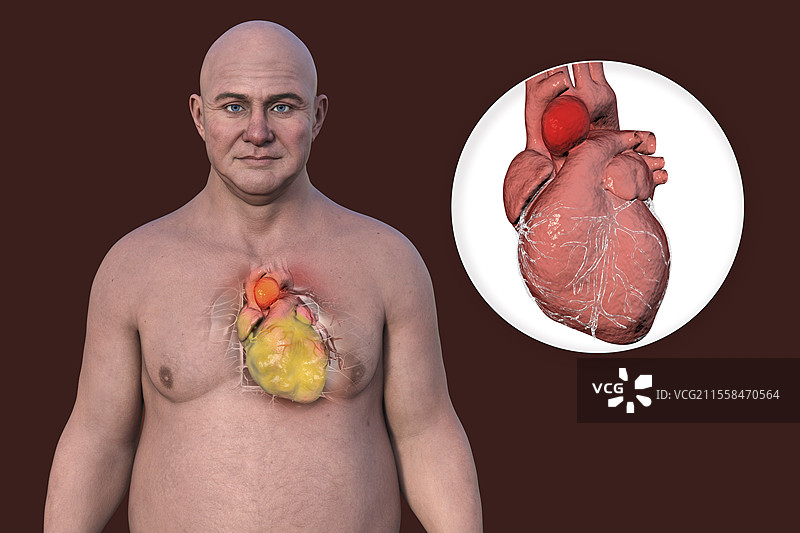 肥厚心脏和主动脉瘤插图图片素材