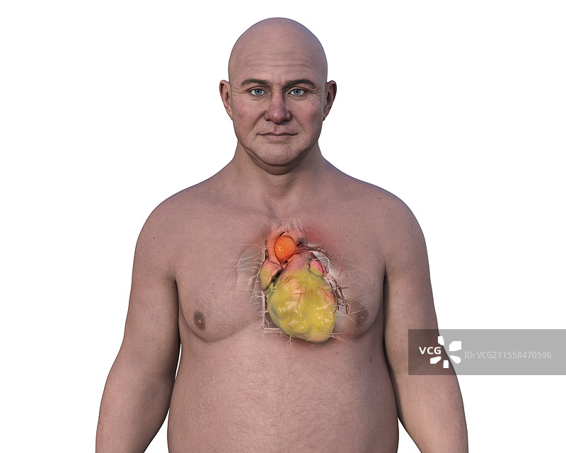 肥厚心脏和主动脉瘤插图图片素材