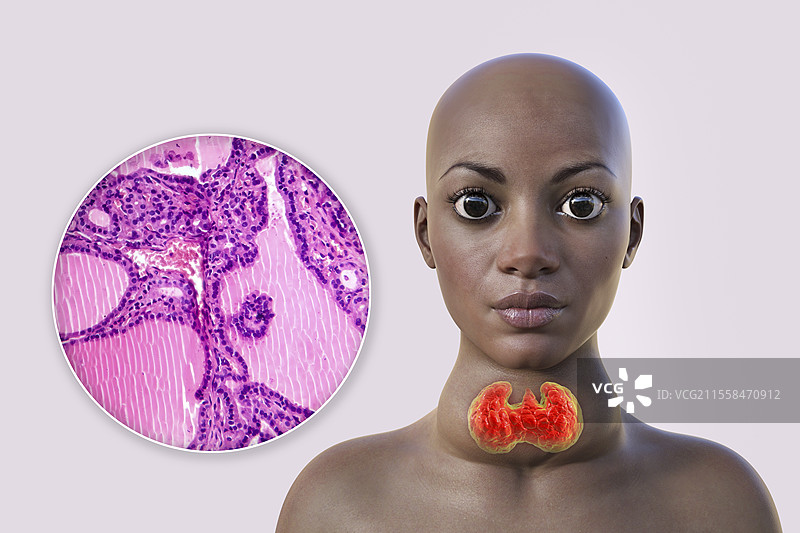 女性甲状腺肿大和突眼症的插图图片素材