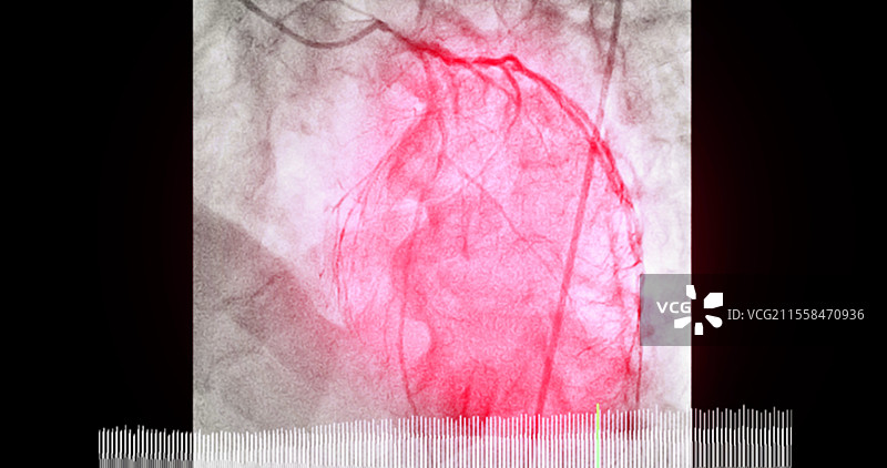 气球治疗堵塞动脉，血管造影图片素材