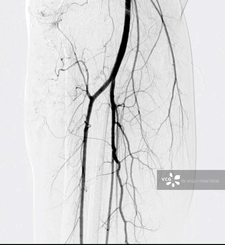 气球治疗堵塞动脉，血管造影图片素材