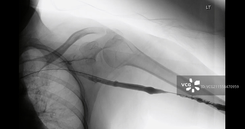 气球治疗阻塞的锁骨下动脉，血管造影图片素材