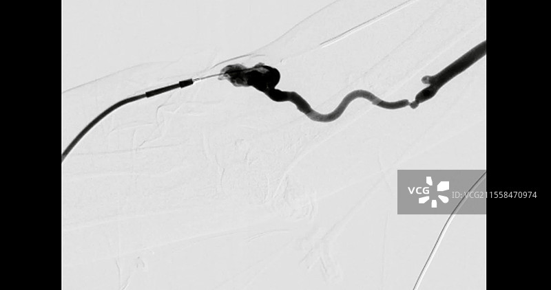 气球治疗和支架用于阻塞动脉，血管造影图片素材