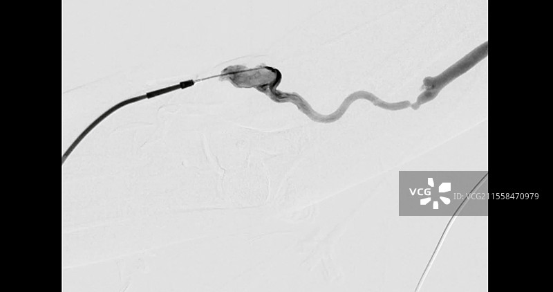 气球治疗和支架用于阻塞动脉，血管造影图片素材