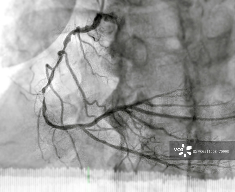 气球治疗堵塞动脉，血管造影图片素材