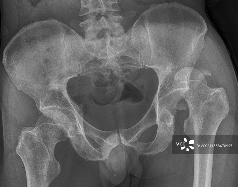 骨盆骨折，X光片图片素材