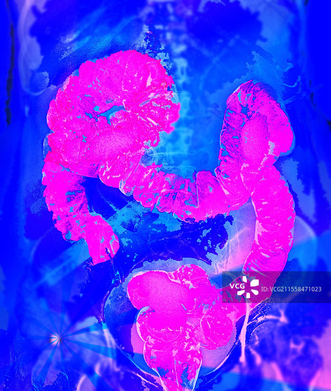 健康的结肠，X光检查图片素材