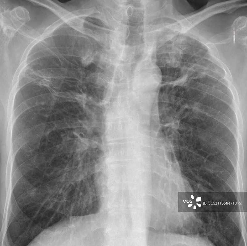 结核病，X光检查图片素材